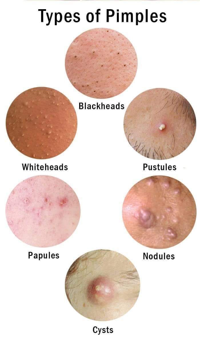 Pimples